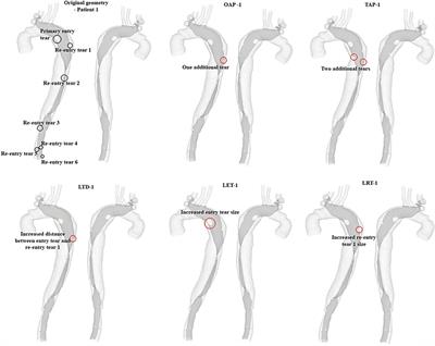 A computational study of the effects of size, location, and number of tears on haemodynamics in surgically repaired type A aortic dissection